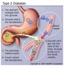 Type 2 Diabetes