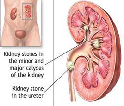 Kidney Stones