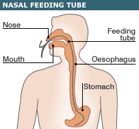 Tube Feeding