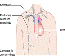 Parenteral Feeding